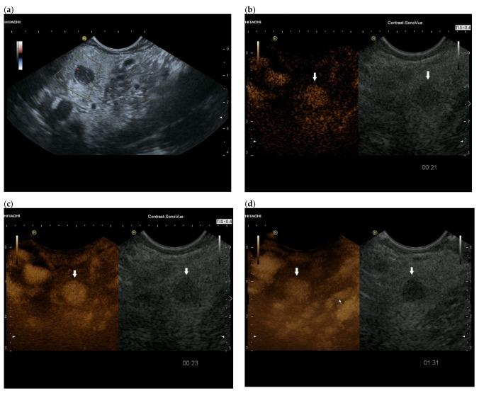 https://cdn.ncbi.nlm.nih.gov/pmc/blobs/5f61/10177255/9d7b482c1b68/cancers-15-02546-g004.jpg