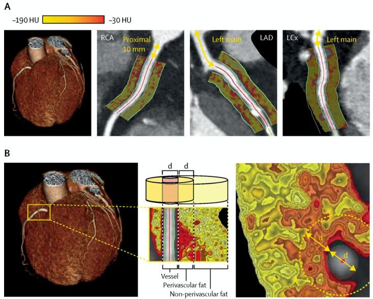 https://cdn.ncbi.nlm.nih.gov/pmc/blobs/5f9c/9326642/912692e33cf1/tomography-08-00147-g004.jpg