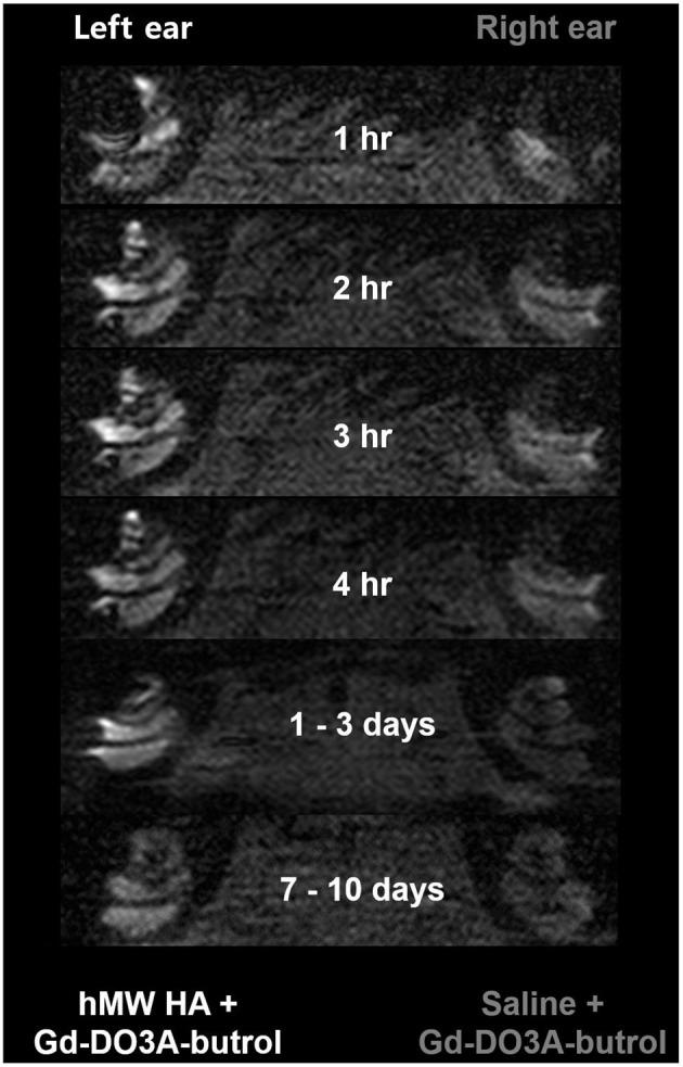https://cdn.ncbi.nlm.nih.gov/pmc/blobs/5fd3/8263933/488260613053/fneur-12-650884-g0004.jpg