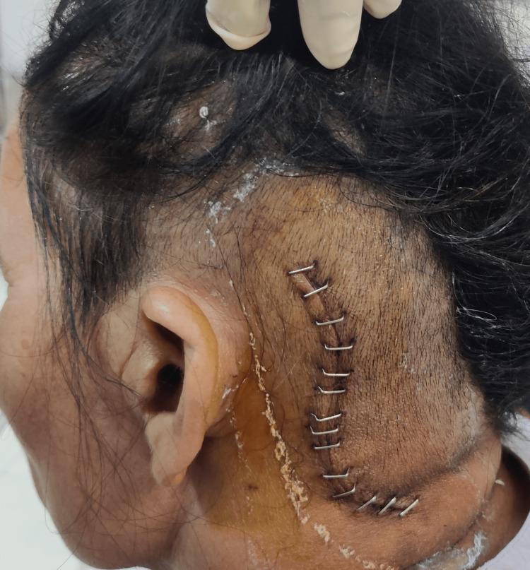 https://cdn.ncbi.nlm.nih.gov/pmc/blobs/5fe7/10576441/57a5216ca5d4/cureus-0015-00000045224-i02.jpg