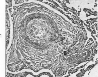 https://cdn.ncbi.nlm.nih.gov/pmc/blobs/600f/1942376/4d10bc616e3e/amjpathol00332-0096-a.jpg