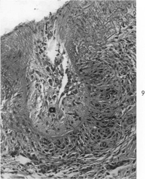 https://cdn.ncbi.nlm.nih.gov/pmc/blobs/600f/1942376/b68717d5524b/amjpathol00332-0098-c.jpg