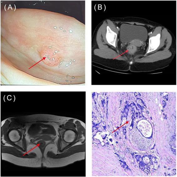https://cdn.ncbi.nlm.nih.gov/pmc/blobs/6051/10030915/1dd0c5e444ba/fmed-10-1128084-g003.jpg