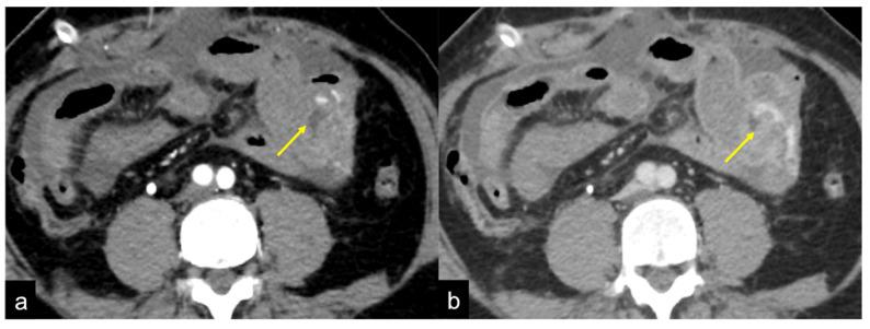 https://cdn.ncbi.nlm.nih.gov/pmc/blobs/605f/9606936/6f621a05ba4b/tomography-08-00198-g010.jpg