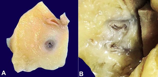 https://cdn.ncbi.nlm.nih.gov/pmc/blobs/6089/8387068/f357904da0fb/autopsy-11-e2021310-g01.jpg