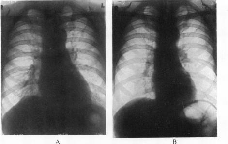 https://cdn.ncbi.nlm.nih.gov/pmc/blobs/60b9/503432/5f1fcbf04c1d/brheartj00449-0015-a.jpg