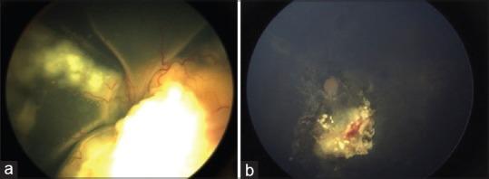 https://cdn.ncbi.nlm.nih.gov/pmc/blobs/60c5/6552585/4b16093cce8b/IJO-67-740-g008.jpg