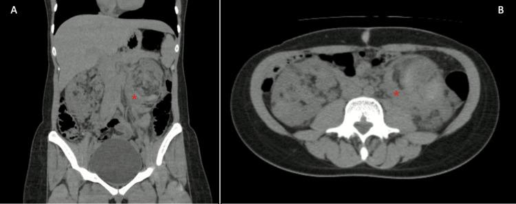 https://cdn.ncbi.nlm.nih.gov/pmc/blobs/6128/10320413/0aa2ab68898f/cureus-0015-00000041385-i02.jpg