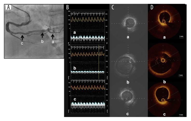 https://cdn.ncbi.nlm.nih.gov/pmc/blobs/6131/5156557/10d84677ceea/amjcaserep-17-939-g003.jpg