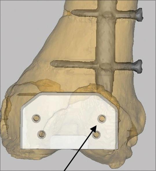 https://cdn.ncbi.nlm.nih.gov/pmc/blobs/616a/5858209/3d218729b621/IJOrtho-52-154-g001.jpg