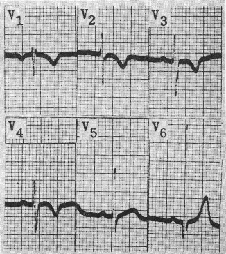 https://cdn.ncbi.nlm.nih.gov/pmc/blobs/6182/491800/f870a027ad7b/brheartj00378-0056-c.jpg