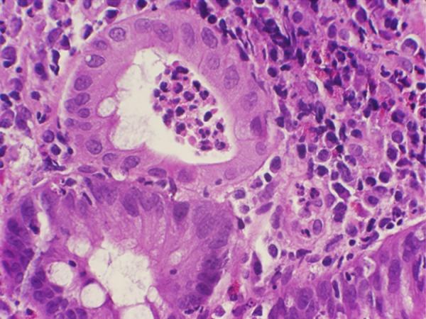 https://cdn.ncbi.nlm.nih.gov/pmc/blobs/6199/4968430/97278af92ff3/amjcaserep-17-538-g004.jpg