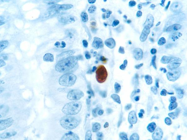 https://cdn.ncbi.nlm.nih.gov/pmc/blobs/6199/4968430/fc3794b6c84c/amjcaserep-17-538-g003.jpg
