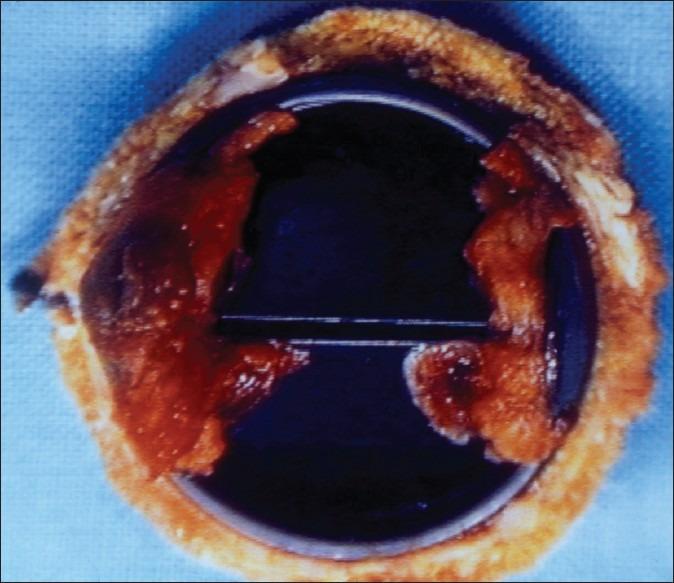 https://cdn.ncbi.nlm.nih.gov/pmc/blobs/61f4/3425031/71707c98c7d9/JCDR-3-228-g003.jpg
