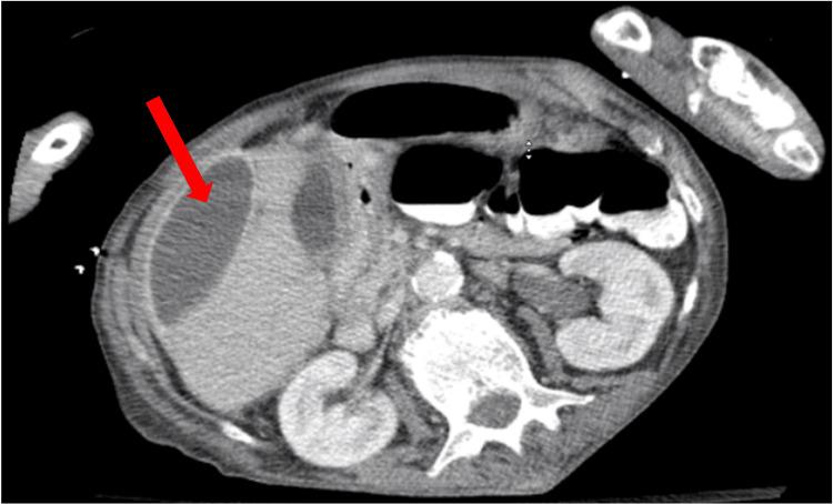 https://cdn.ncbi.nlm.nih.gov/pmc/blobs/61ff/12398322/1865f7e78d4f/cureus-0017-00000089011-i04.jpg