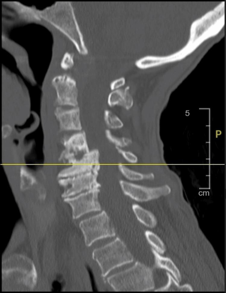https://cdn.ncbi.nlm.nih.gov/pmc/blobs/61ff/12398322/51cabf2e854c/cureus-0017-00000089011-i02.jpg