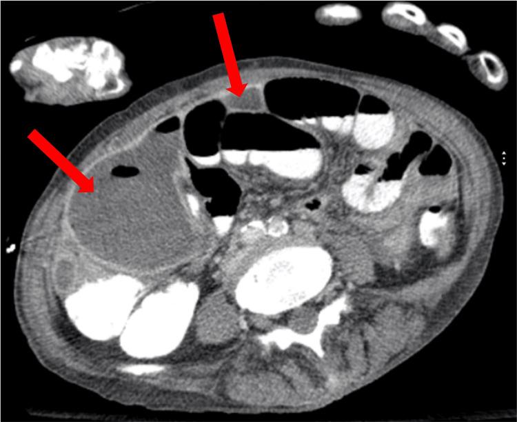 https://cdn.ncbi.nlm.nih.gov/pmc/blobs/61ff/12398322/e018b2c85a0d/cureus-0017-00000089011-i05.jpg