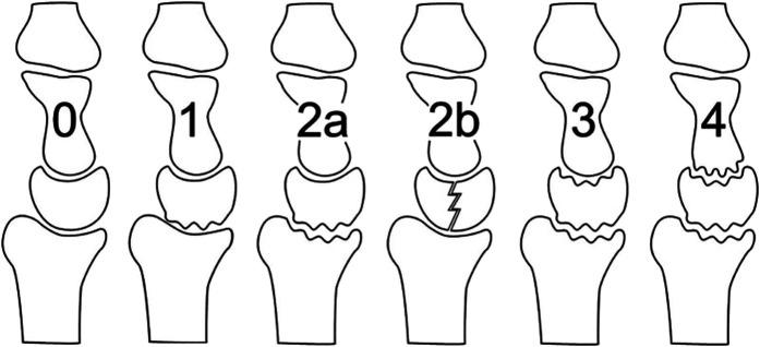 https://cdn.ncbi.nlm.nih.gov/pmc/blobs/620b/12160086/2b2527aa62ac/jbjsam-107-1389-g004.jpg