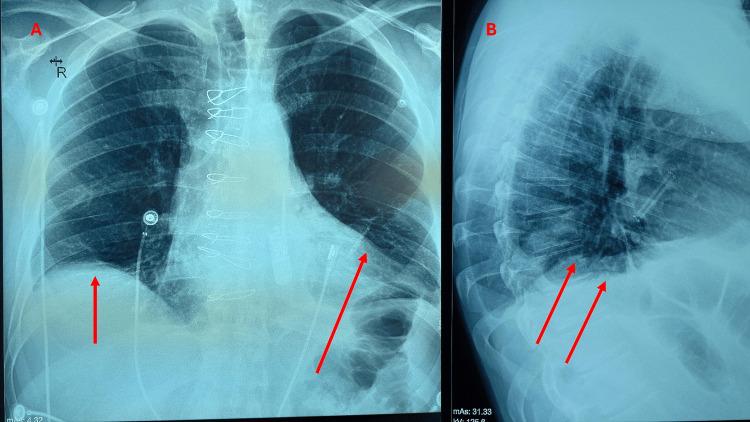 https://cdn.ncbi.nlm.nih.gov/pmc/blobs/6216/10823461/7ae7e215fa71/cureus-0016-00000053143-i02.jpg