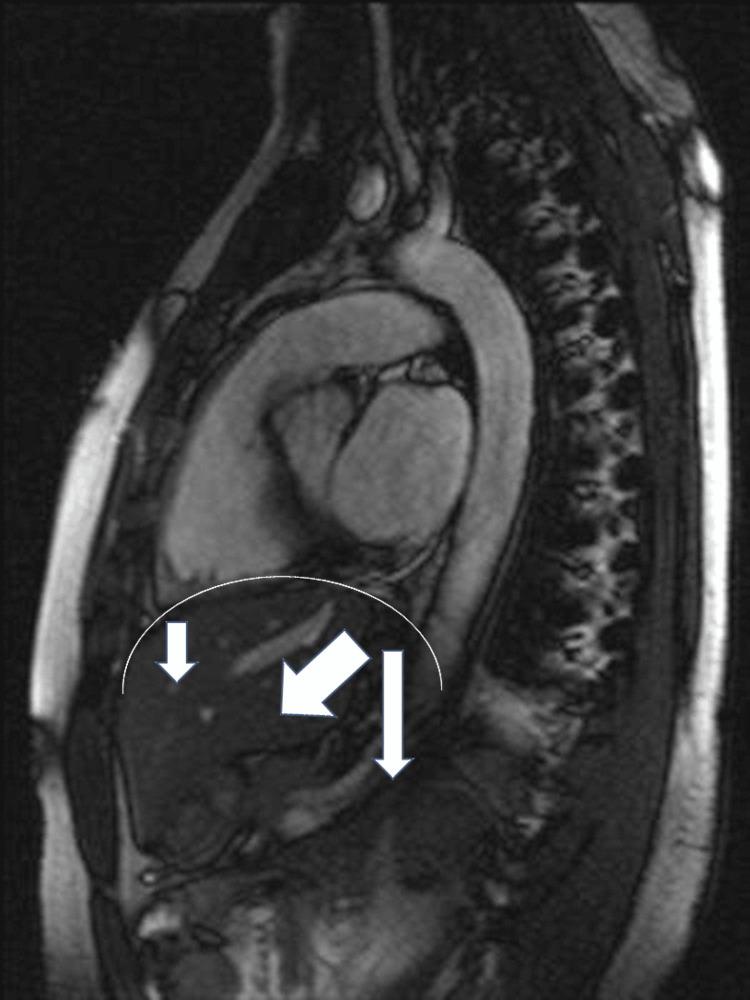 https://cdn.ncbi.nlm.nih.gov/pmc/blobs/6216/10823461/96ffc7f94939/cureus-0016-00000053143-i01.jpg