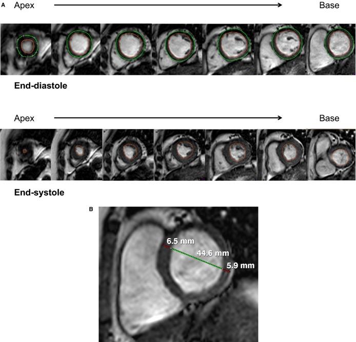 https://cdn.ncbi.nlm.nih.gov/pmc/blobs/624b/4599505/165ba4ec74a2/jah30004-e002188-f1.jpg