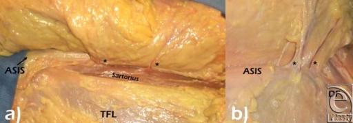 https://cdn.ncbi.nlm.nih.gov/pmc/blobs/6257/2808053/aeec00687991/eplasty10e11_fig6.jpg