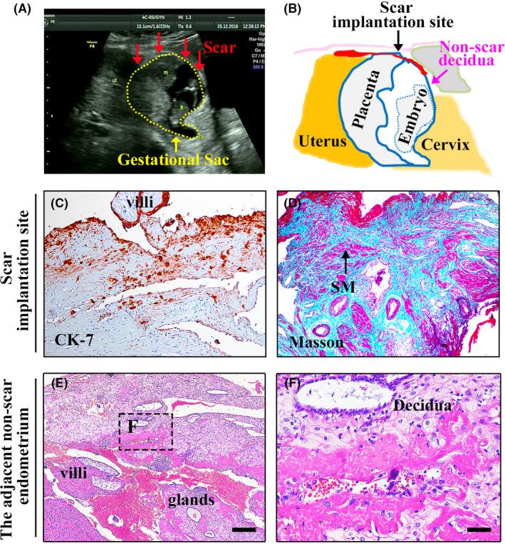 https://cdn.ncbi.nlm.nih.gov/pmc/blobs/6257/9812109/78478f79d3b9/AOGS-101-1120-g002.jpg