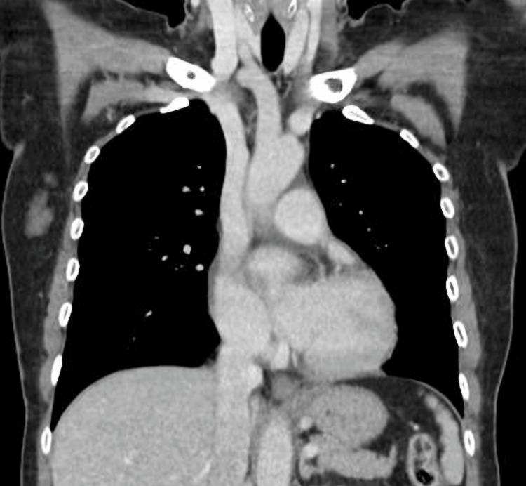 https://cdn.ncbi.nlm.nih.gov/pmc/blobs/6263/12373361/481b31fa7c08/cureus-0017-00000088611-i03.jpg
