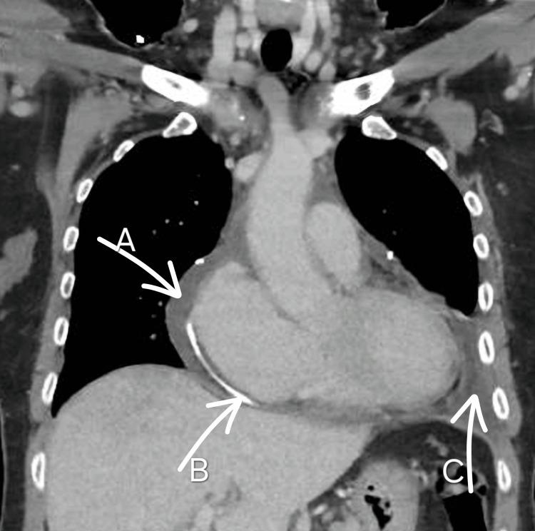 https://cdn.ncbi.nlm.nih.gov/pmc/blobs/6263/12373361/b823a74b68a6/cureus-0017-00000088611-i02.jpg