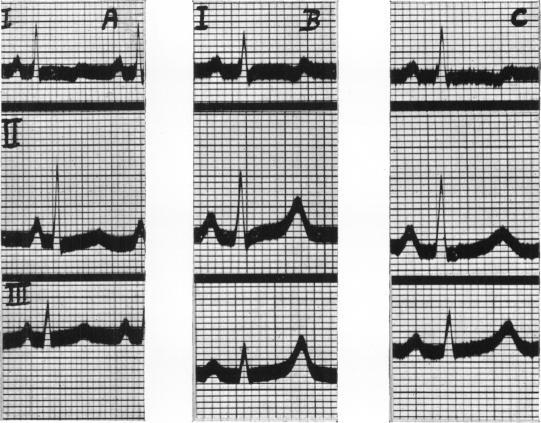 https://cdn.ncbi.nlm.nih.gov/pmc/blobs/62a2/503410/a6951947e065/brheartj00453-0003-a.jpg