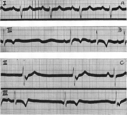 https://cdn.ncbi.nlm.nih.gov/pmc/blobs/62a2/503410/ada286001a47/brheartj00453-0008-a.jpg