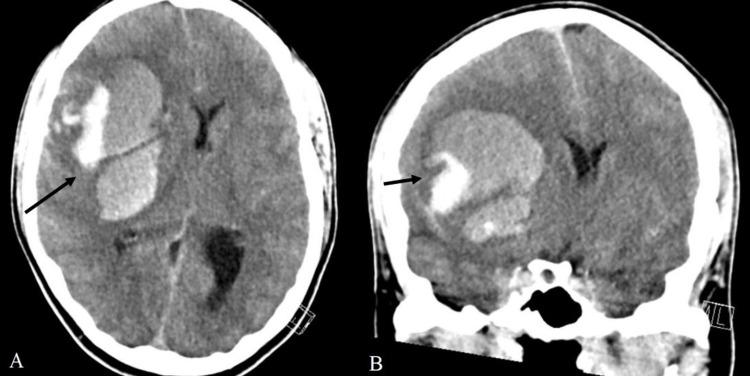 https://cdn.ncbi.nlm.nih.gov/pmc/blobs/62ac/8486363/49a87d8dab93/cureus-0013-00000017637-i01.jpg