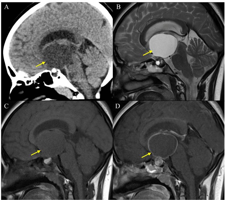 https://cdn.ncbi.nlm.nih.gov/pmc/blobs/62e1/11324331/217b0831170e/cureus-0016-00000064606-i05.jpg