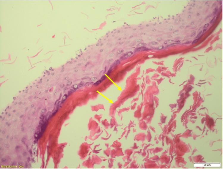 https://cdn.ncbi.nlm.nih.gov/pmc/blobs/62e1/11324331/8046585d105f/cureus-0016-00000064606-i04.jpg