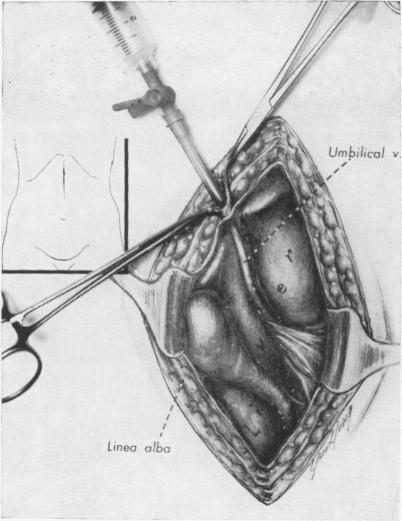 https://cdn.ncbi.nlm.nih.gov/pmc/blobs/62e2/1397305/071c01572e38/annsurg00405-0068-a.jpg