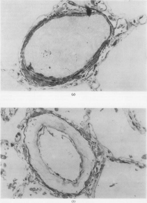 https://cdn.ncbi.nlm.nih.gov/pmc/blobs/62f1/470651/c283138431c5/thorax00154-0088-a.jpg