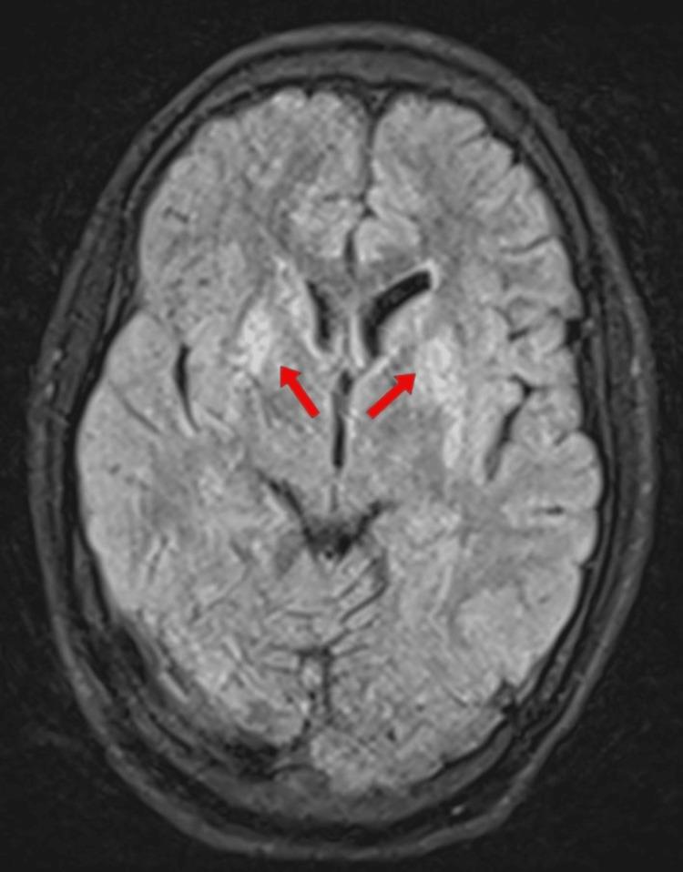 https://cdn.ncbi.nlm.nih.gov/pmc/blobs/62fe/11848242/c1de82e3d199/cureus-0017-00000077891-i04.jpg