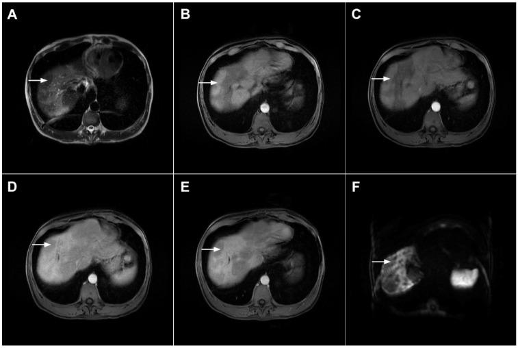https://cdn.ncbi.nlm.nih.gov/pmc/blobs/636f/8870737/755b42c62dc6/curroncol-29-00061-g008.jpg