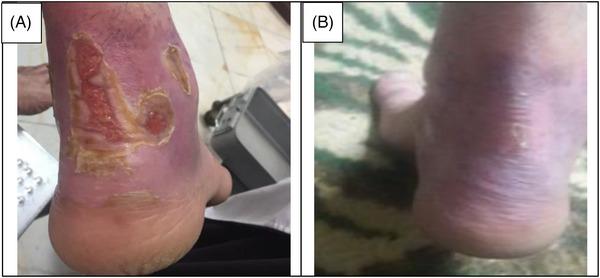 https://cdn.ncbi.nlm.nih.gov/pmc/blobs/63ab/10511837/2dd82eabf9e0/SRT-29-e13471-g003.jpg