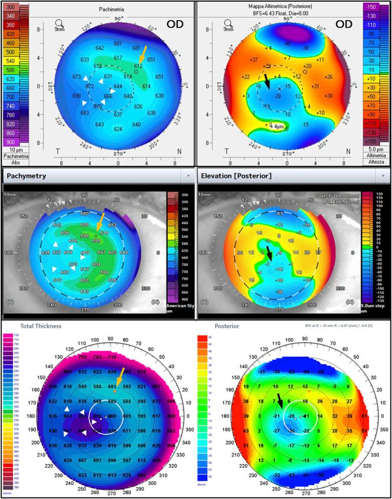 https://cdn.ncbi.nlm.nih.gov/pmc/blobs/63c0/11608617/57da2cac8720/cornea-44-039-g001.jpg