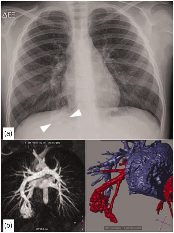 https://cdn.ncbi.nlm.nih.gov/pmc/blobs/6403/6545655/08e29a171bd2/10.1177_2058460119851998-fig13.jpg