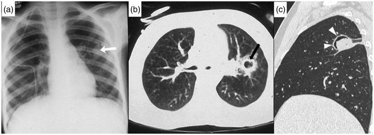 https://cdn.ncbi.nlm.nih.gov/pmc/blobs/6403/6545655/6031c69666ac/10.1177_2058460119851998-fig6.jpg