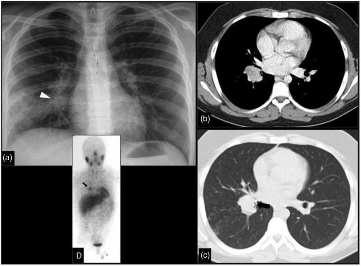 https://cdn.ncbi.nlm.nih.gov/pmc/blobs/6403/6545655/6b9f72e085d8/10.1177_2058460119851998-fig11.jpg