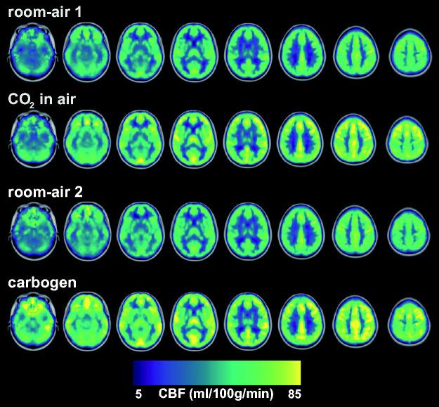 https://cdn.ncbi.nlm.nih.gov/pmc/blobs/6419/9014679/a130523dd0b3/10.1177_0271678X211064572-fig4.jpg