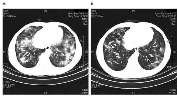 https://cdn.ncbi.nlm.nih.gov/pmc/blobs/646b/2842275/ccd77eeeac99/1471-2334-10-64-1.jpg