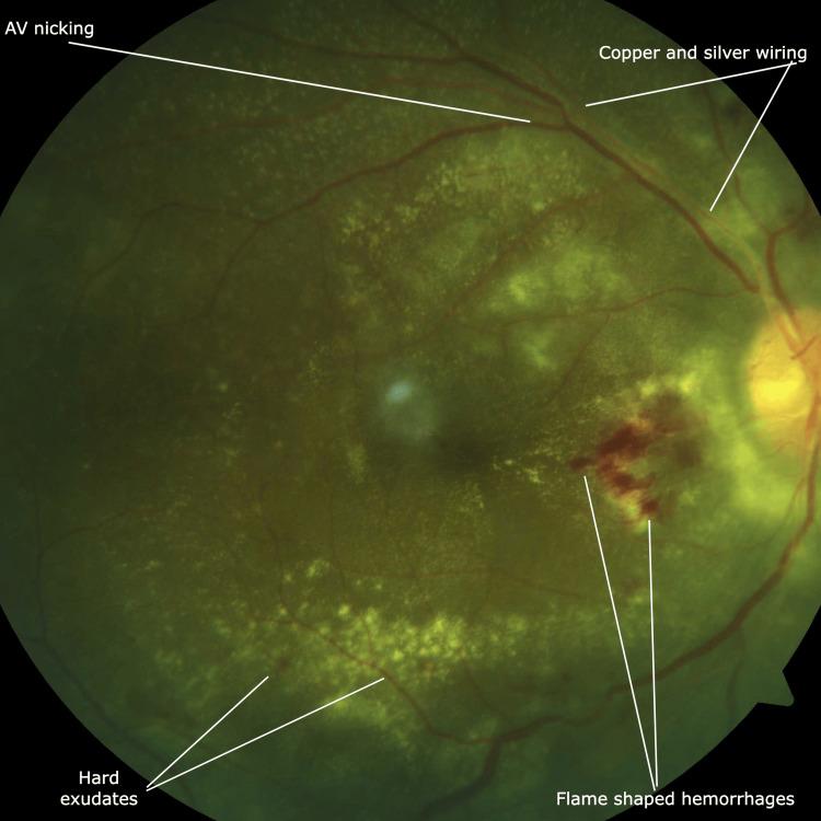 https://cdn.ncbi.nlm.nih.gov/pmc/blobs/6478/11646172/ce6fb036ad5b/cureus-0016-00000073632-i02.jpg