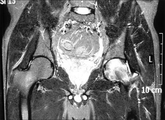 https://cdn.ncbi.nlm.nih.gov/pmc/blobs/6491/5525527/bfcef6659f4b/IJOrtho-51-455-g003.jpg
