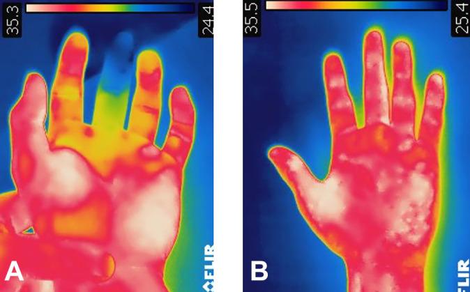 https://cdn.ncbi.nlm.nih.gov/pmc/blobs/649b/7418254/e6d85654c2e6/10.1177_2325967120942064-fig6.jpg