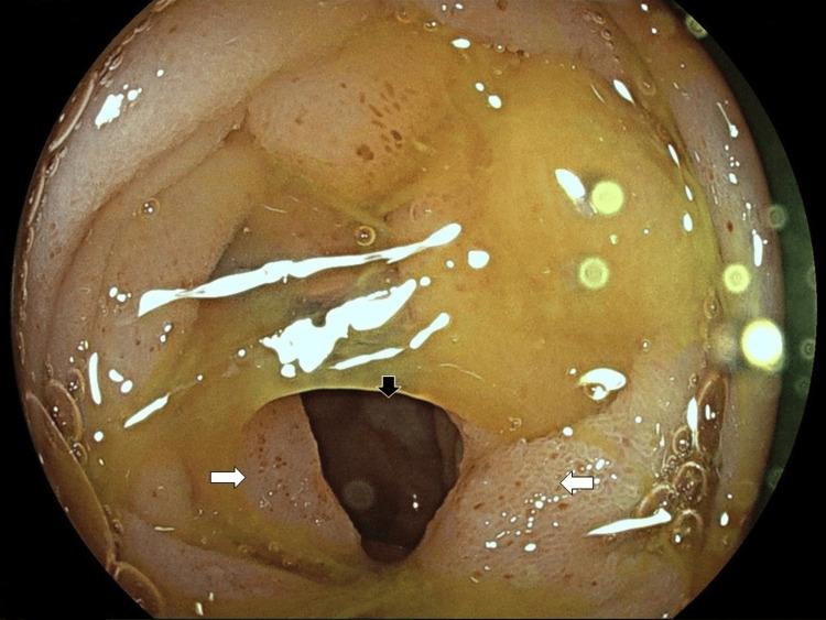 https://cdn.ncbi.nlm.nih.gov/pmc/blobs/649e/11126889/5e04efc0e008/cureus-0016-00000058964-i02.jpg