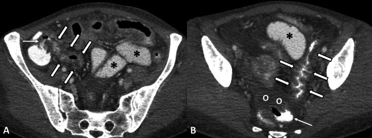https://cdn.ncbi.nlm.nih.gov/pmc/blobs/649e/11126889/a17c2d395b24/cureus-0016-00000058964-i01.jpg